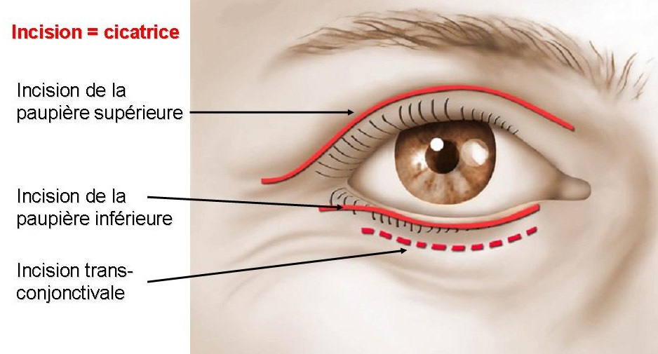 Blepharoplastie SUPPERIEURE